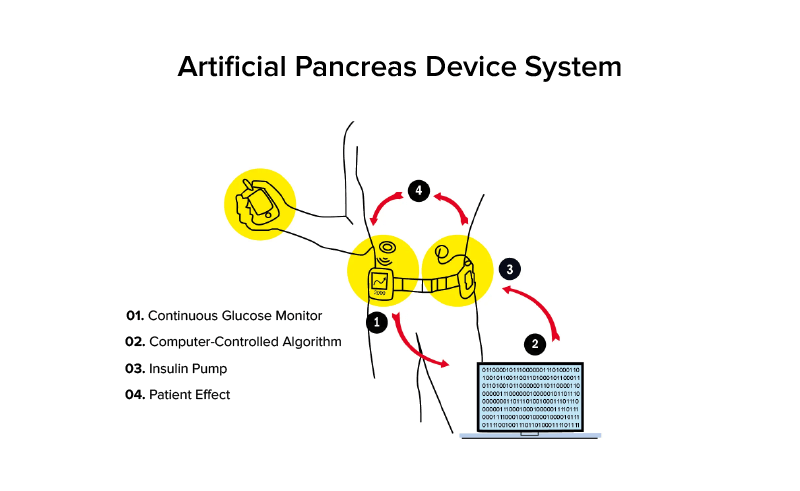 Artificial Pancreas Device System